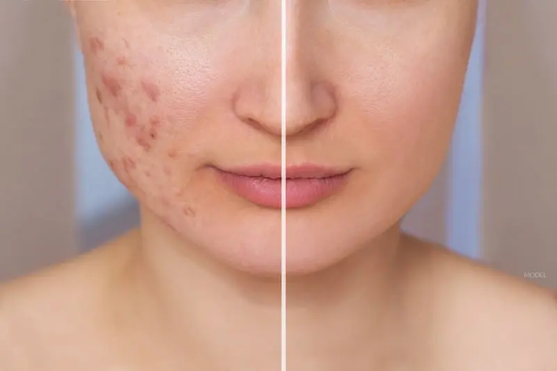 Home Acne & Acne Scars Treatment