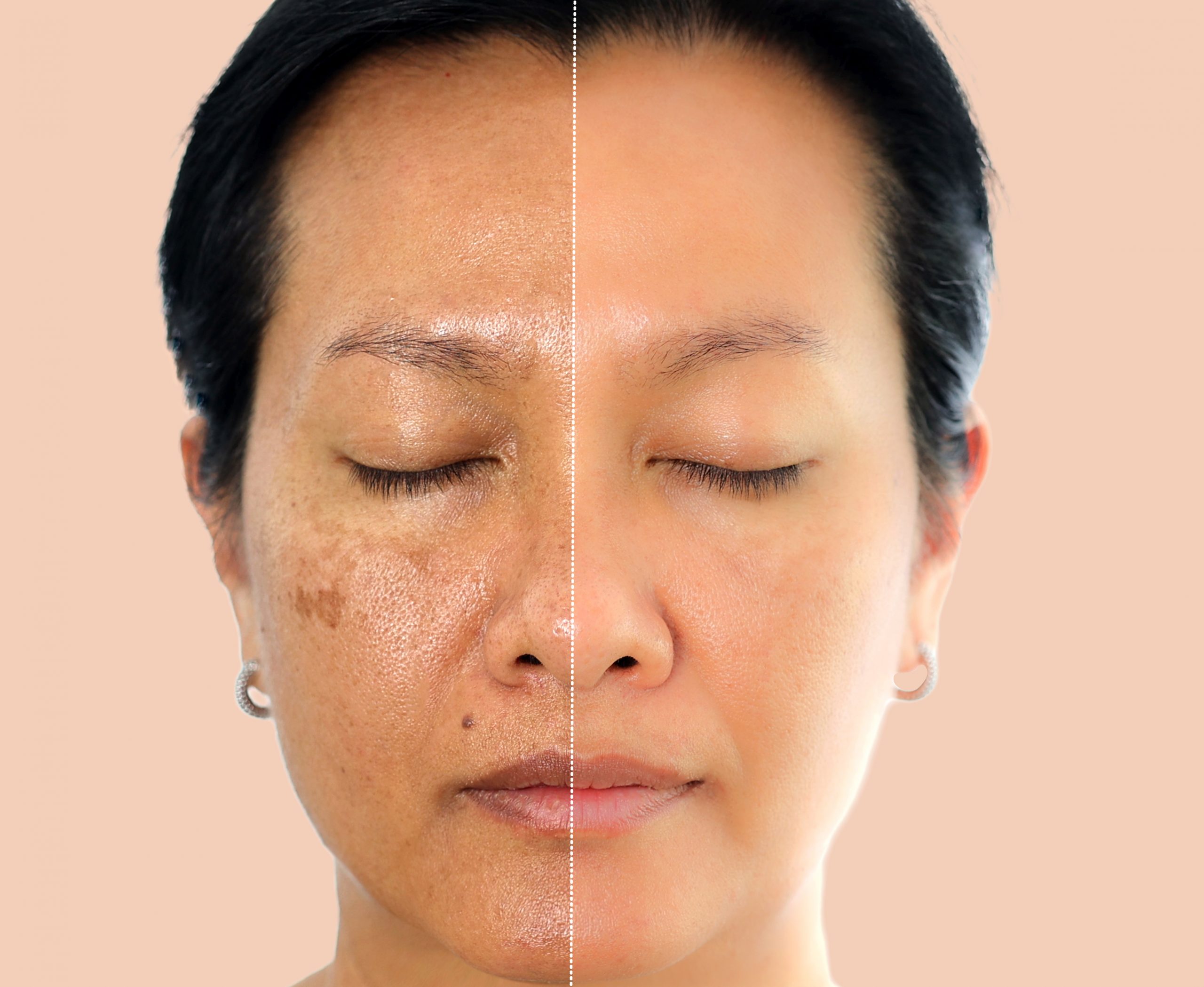 Home Pigmentation Removal