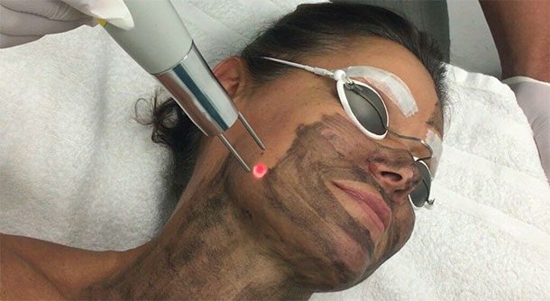 Home Carbon Laser Facial