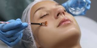 Home Chemical Peel