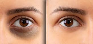 Home Dark Circles Treatment