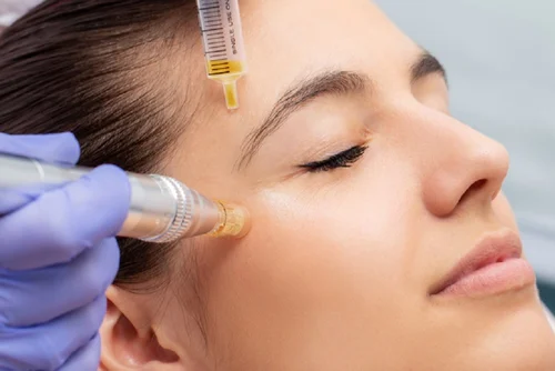 Home Vampire PRP Facial