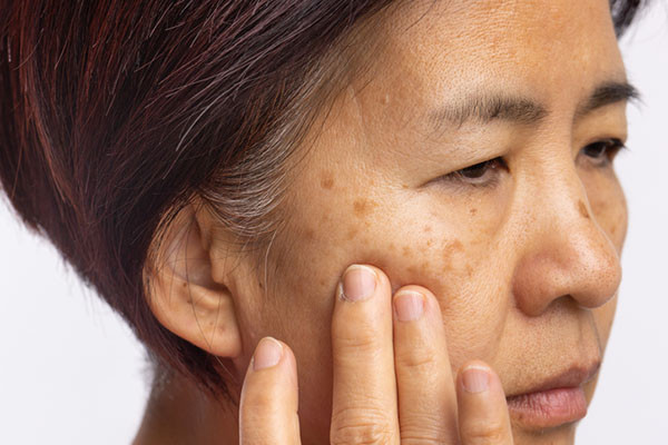 Home Melasma & Spots Reduction