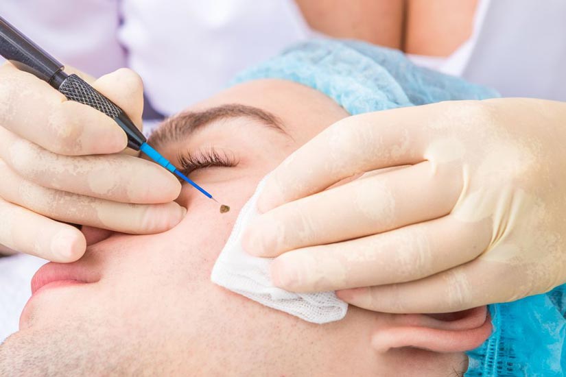 Home Mole & Skin Tag Removal